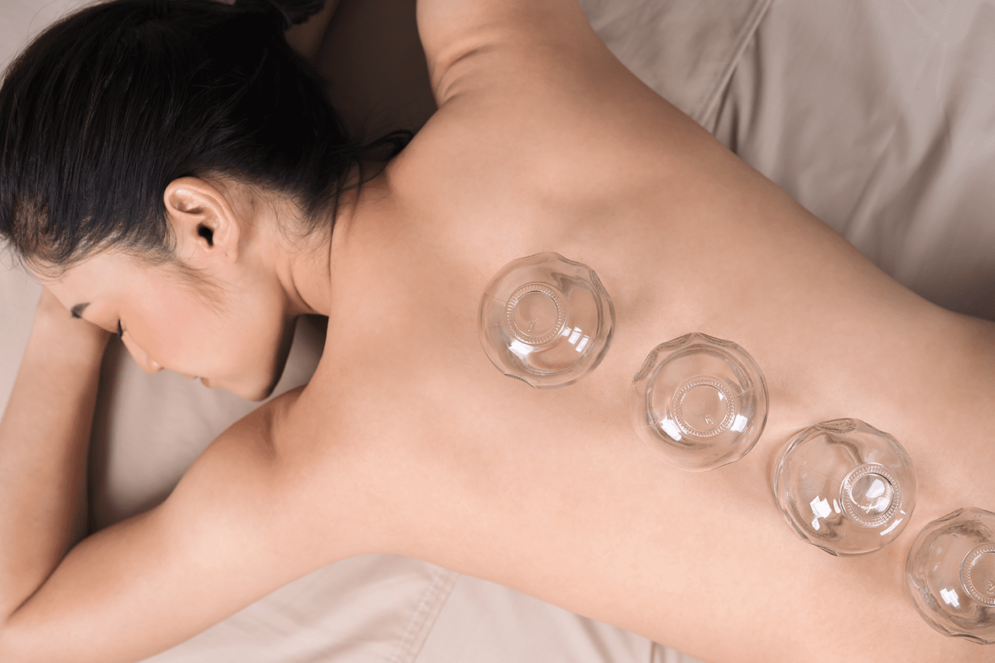 cupping_therapy